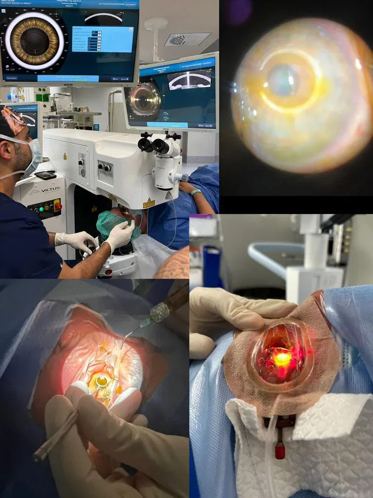 SLOWING OF KERATOCONUS PROGRESSION