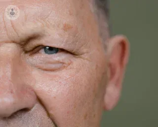 Luz Pulsada Intensa (IPL) como novedoso tratamiento para el ojo seco