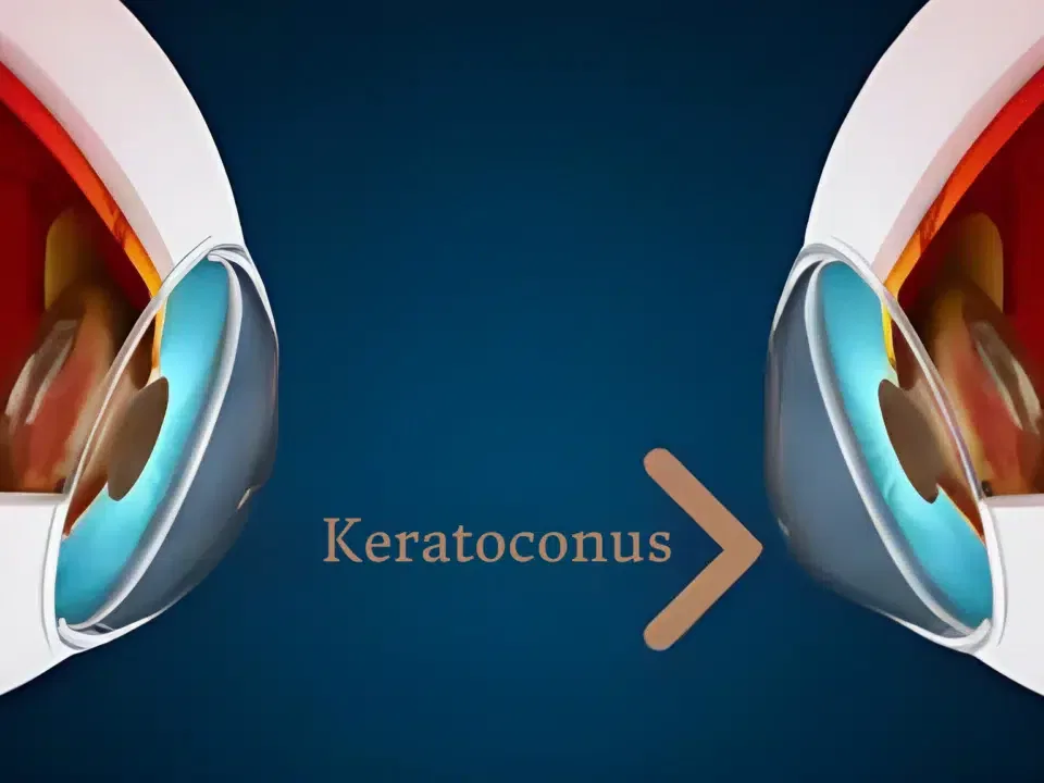 ¿QUÉ ES EL QUERATOCONO?