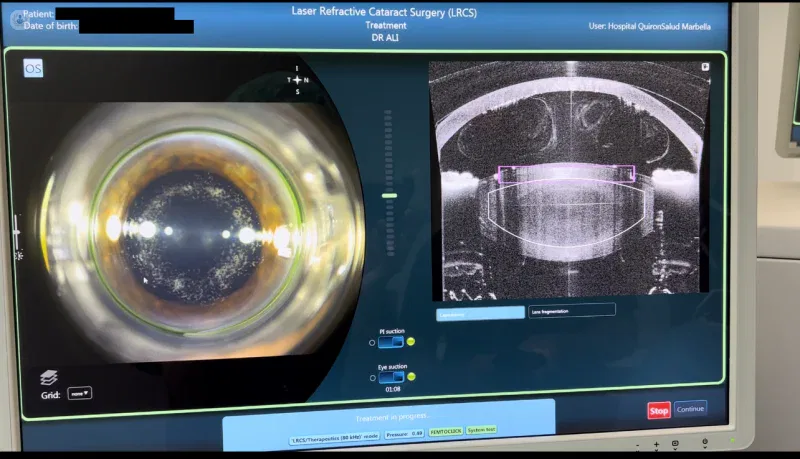 Imagen de un sistema de cirugía de cataratas con láser, mostrando la visualización de la lente ocular y un escáner de tomografía. La pantalla presenta información técnica sobre el procedimiento.