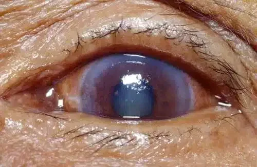 Primer plano de un ojo humano con cataratas, mostrando la opacidad del cristalino y la textura de la piel alrededor. Ideal para temas de salud ocular y condiciones visuales.