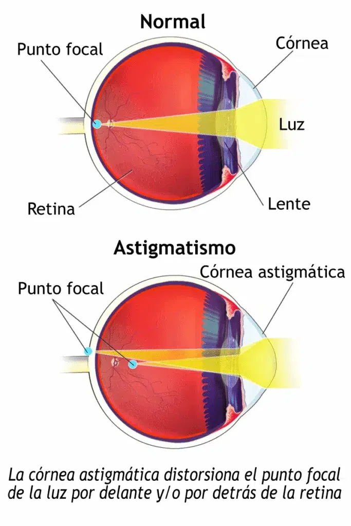 astigmatismo