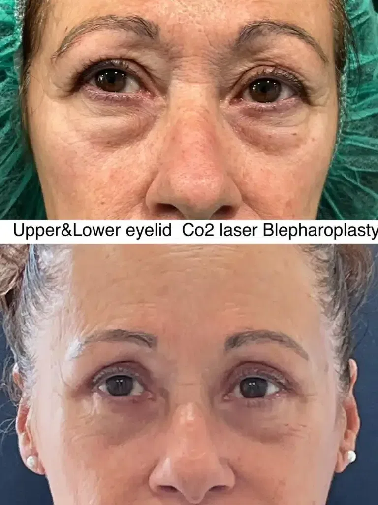 Antes y después de una blefaroplastia láser CO2 en párpados superiores e inferiores, mostrando mejoría en la apariencia de las ojeras y la piel alrededor de los ojos.