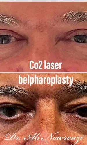 Imagen que muestra el antes y después de un paciente tras una blefaroplastia y tratamiento con láser CO2. La parte superior muestra el resultado después del procedimiento, destacando un aspecto rejuvenecido alrededor de los ojos. La parte inferior presenta la imagen del paciente antes de la cirugía, con signos visibles de envejecimiento.