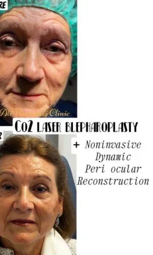 Imagen que muestra el antes y después de un procedimiento de blefaroplastia con láser CO2, destacando la mejora en la apariencia de la piel periocular. El tratamiento es no invasivo y dinámico, enfocado en la reconstrucción de la zona alrededor de los ojos.